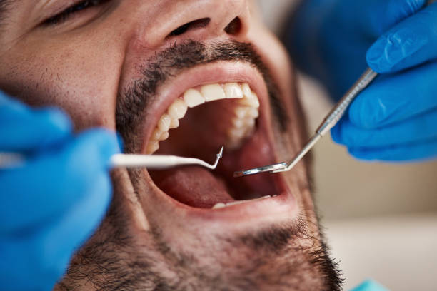 Best Emergency Dentist for Lost Fillings or Crowns in Belleair Bluffs, FL